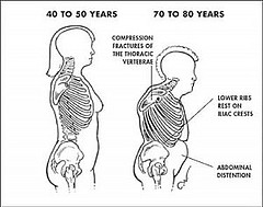 Dowagers Hump Caused by Poor Posture