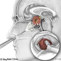 how transphenoidal surgery is performed