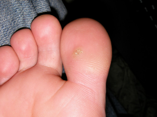 Plantar wart on the right toe