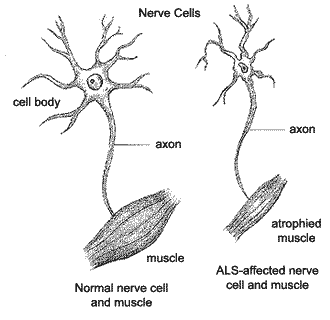 Compare normal nerve cells and muscles with those of an ALS patient.