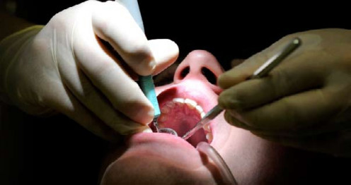 Surgery for Oral Cancer