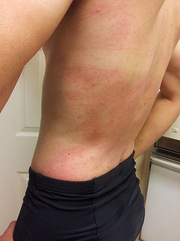 Allergy on the Skin