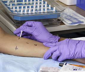 Skin Testing for Allergy
