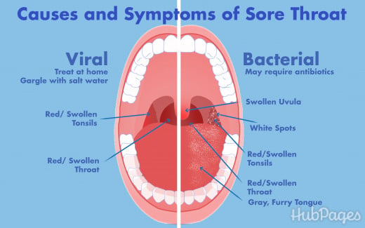 Sore Throat at Night: Symptoms, Causes, and Treatment