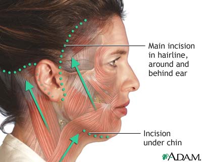 In a traditional facelift, the plastic surgeon makes incisions above the hairline at the temples, behind the earlobe, to the lower scalp, removing some of the fat tissue and loose skin. The surgeon then stitches the incisions closed.   