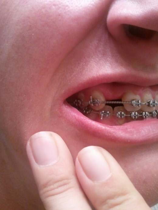 March 14, 2012 - These teeth are straightening out as well. No more strong angulation on that upper second tooth from the left like there was before :)