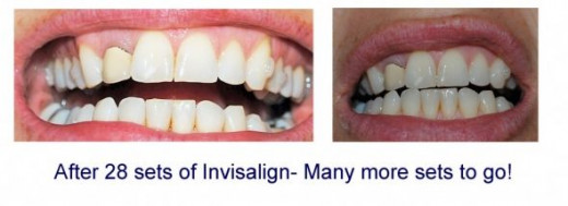 Invisalign Braces Before And After Pictures set 28