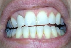 Fifty sets of Invisalign