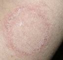 Yummy...it's ringworm! Get help from your doctor!