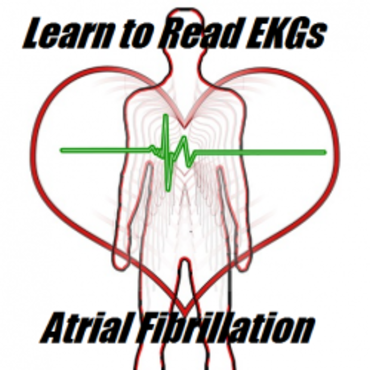 The Basics of Ekg Interpretation and Rhythm Recognition: Atrial Fibrillation