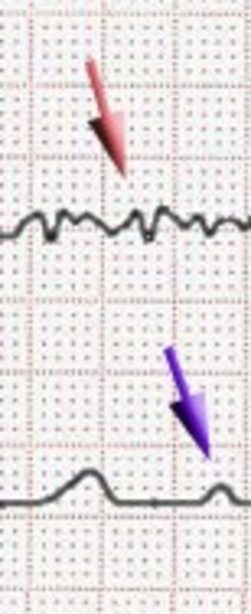 Atrial Fibrillation EKG baseline
