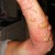 photo: poison-ivy.org Nasty blisters from contact with poison ivy photo: poison-ivy.org Nasty blisters from contact with poison ivy