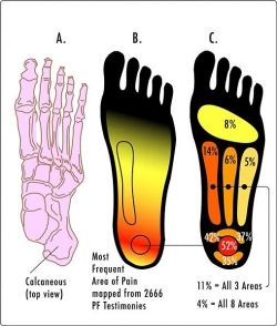 Plantar Fasciitis pain is most commonly felt in the heel of the foot.